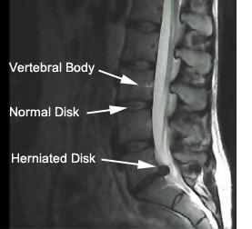 HERNIATED DISC Can be a Cause of Sciatica 