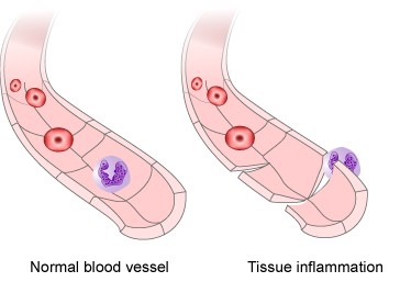 inflammation