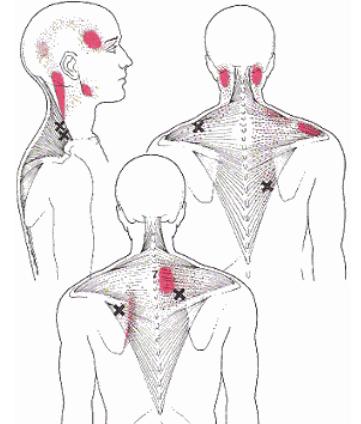 neck shoulder back pain
