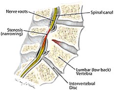 Spinal Stenosis Explanation