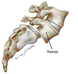 sciatica isthmic s.