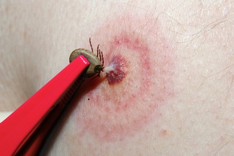 lyme disease rash