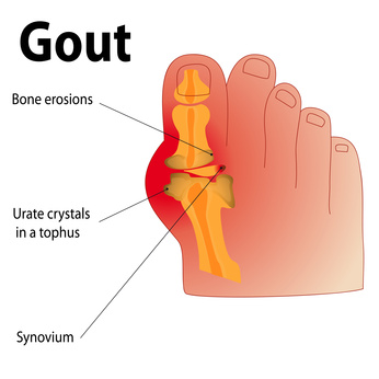 Gout 