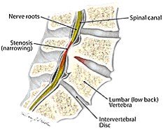 Spinal Stenosis Explanation